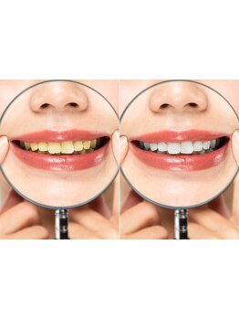 美白ケアをしたい