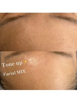 ボーホーアフロ(BOHO AFRO)/フェイシャルMIX脱毛