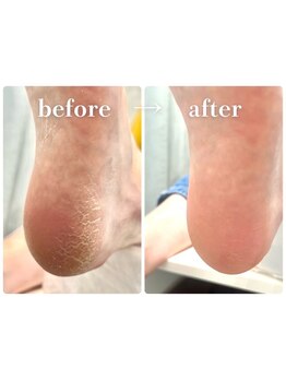 角質ケアができるサロン