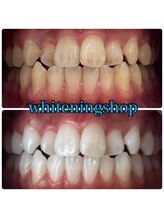 ホワイトニングショップ 武蔵小杉店/【BeforeAfter】10回 施術後比較