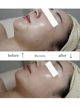 トット 恵比寿(totto)の写真/１dayからしっかり仕上げ☆リフトアップたるみケアで透明感のある小顔へ◎夫婦ペア割りでお得に美しく！