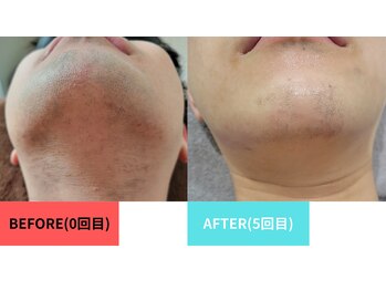 マーレ(MARE)の写真/ヒゲ脱毛、VIOもOK！都度払い、お得なコースもご用意あり♪自己処理が難しい箇所はプロにお任せ下さい◎