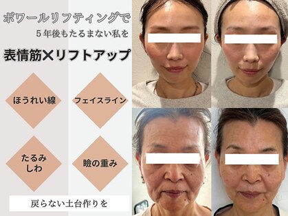 ミラーレ(Mirare)の写真