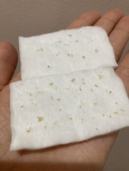 シャルム(Sharm)/毛穴エクストラクション