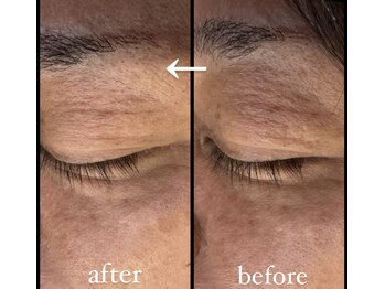 フェアリー/最先端★シワプラズマでケア!