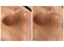 イヴ(Yves)/毛穴洗浄before/after