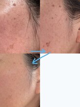 ソラ(Sola)/シミケア特化フェイシャル