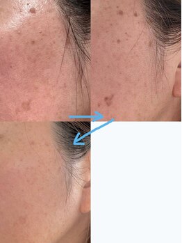 ソラ(Sola)/シミケア特化フェイシャル