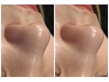 八女整体院/～ハイドラ毛穴洗浄～