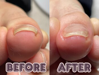 ポドロ ウィズ ニコルル 大阪天満店(PoDoLo with Nicolulu)/【巻き爪】フットケア大阪・梅田