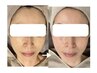 【10:30~14:00限定◆大人女性に人気】シミケアし放題45分¥11,440→¥5,980