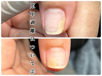 爪甲剥離について