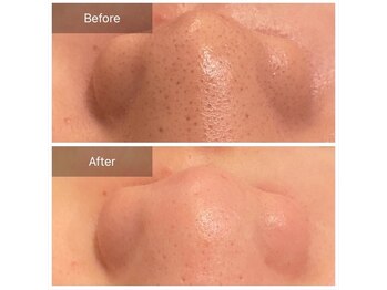 リジュベ(Rejuve)/毛穴エクストラクション[毛穴]