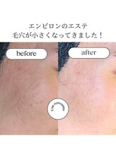 ユヌランコント 岐阜店(Une rencontre)/エンビロン（ピーリング）