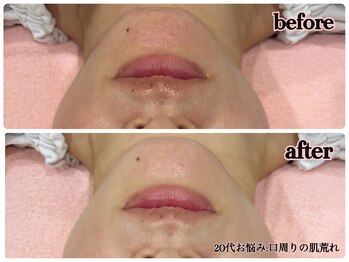 シルク(Cilk)/20代お悩み口周りの肌荒れ