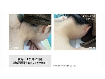 ハクビューティー 那須塩原 黒磯(HAKu beauty)/襟足脱毛
