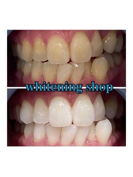 ホワイトニングショップ 所沢店/ホワイトニングショップ所沢店