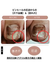 シーエスネイル 元住吉店(CS NAIL)/【巻き爪補正】