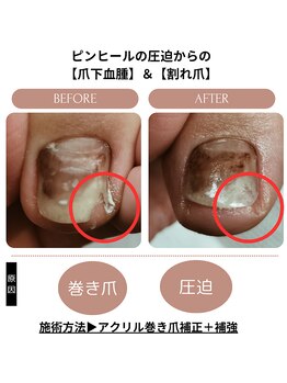 シーエスネイル 元住吉店(CS NAIL)/【巻き爪補正】