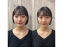 ルアナ(LUANA)/小顔矯正before、after【20代】