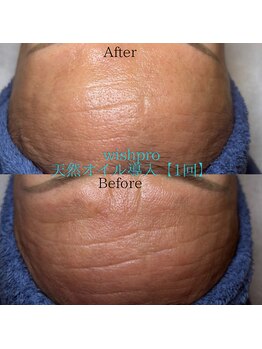 エミナル(EMINALu)/艶や即効性で人気ピーリング