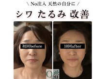 キュープ 相模原淵野辺店(Qpu)/たった4回で人生で1番小さな顔に