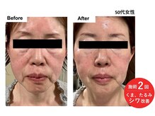 プラズマ +エレクトロポレーションでタルミ改善