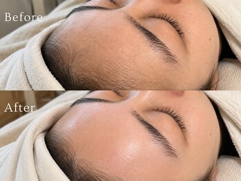 ドレッサー 福岡香椎(DRESSER)の写真/【速効×低刺激★前撮り/挙式前も安心】1度で韓国女優肌**産毛/毛穴/くすみ一掃!艶肌ワックス脱毛¥7480