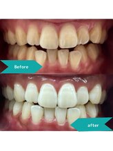 ティンクルホワイト 上尾店/ホワイトニングBefore After