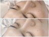 〈時短ケア〉［テカリ/美白/透明感］ブラックソフトハーブピーリング¥13200→