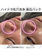 ハリシェンド/ハイドラ毛穴洗浄