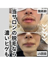 ガランテリー(Galanterie)/濃い青髭もヒゲ脱毛一つで解決