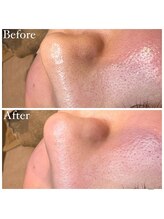 マドモアゼル 麻布十番/毛穴洗浄