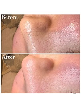 マドモアゼル 麻布十番/毛穴洗浄