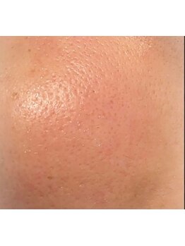 毛穴ケアをしたい