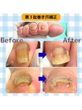 巻き爪補正店 富山店/親指以外の巻き爪