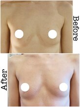 カリーナ(Carina)/バストアップBefore→after