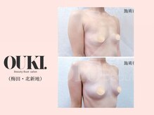 オウキ 梅田北新地(OUKI.)/バストアップ結果写真