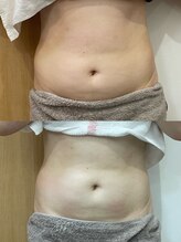 オプレア 千種店(OPREA)/【比較写真】腸セラピー