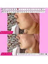 フェミニー(Feminy)/顎下のもたつき撤退