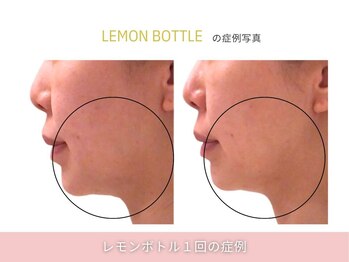 アメリイ 百合ヶ丘 新百合ヶ丘(Amerii)/【レモンボトル】1回の結果