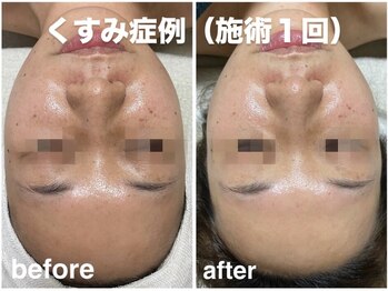 ソフ(soph.)/くすみ症例