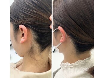 ミース 久留米店/うなじ脱毛体験1回目！