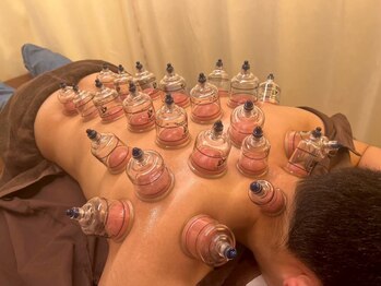 たかさき整骨院/カッピング