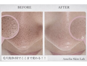 Amelia Skin Lab.天神店【肌質改善/毛穴・ニキビケア/ハーブピーリング】の写真/敏感肌もOK！毛穴の黒ずみ・汚れを優しくオフ×赤みを抑える鎮静ケア。1対1の施術で毛穴の目立たない肌へ！