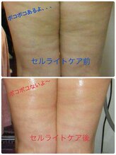 痩身専門サロン ラシュエット(La Chouette)/メソセル痩身