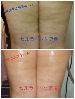 痩身専門サロン ラシュエット(La Chouette)/メソセル痩身