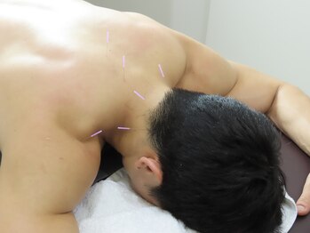 ビーハリット(B-HariT)/【鍼】デスクワーク/筋トレ疲労