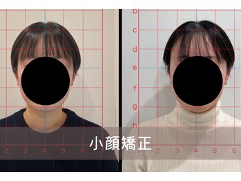 叶'エル 本町 心斎橋院/小顔矯正　3回目