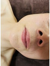 サロン リアン(salon Lien)/フェイシャルOPで、法令線改善！